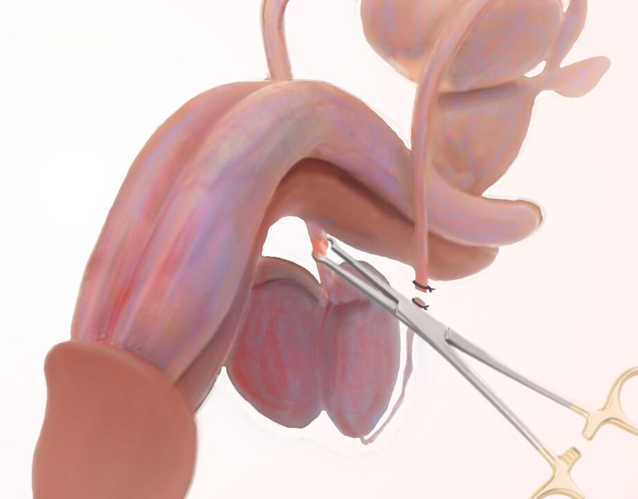 ligamentotomija za povečanje penisa