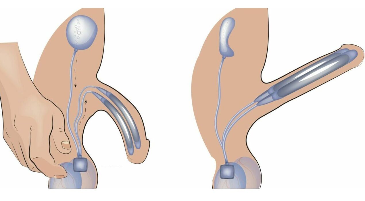 penilna proteza za povečanje penisa